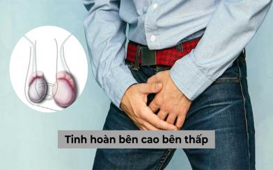 Tinh hoàn bên cao bên thấp là bị gì, có đáng lo không?