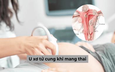 Mắc u xơ tử cung khi mang thai tuyệt đối không được chủ quan