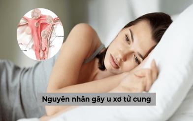 Tìm hiểu những nguyên nhân gây u xơ tử cung và cách điều trị bệnh hiệu quả