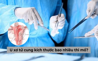 [Góc giải đáp] U xơ tử cung kích thước bao nhiêu thì mổ được?