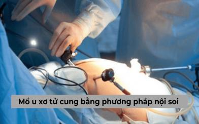 Mổ u xơ tử cung bằng phương pháp nội soi và những thông tin bạn nên biết