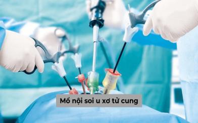 Mổ nội soi u xơ tử cung: Những điều chị em cần biết