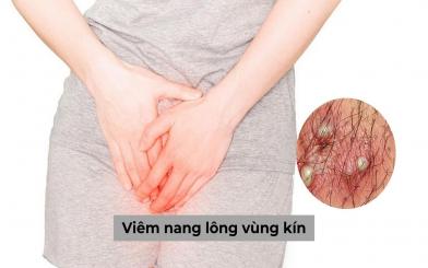 Bạn có biết: Nguyên nhân, dấu hiệu viêm nang lông vùng kín là gì, làm sao để chữa?