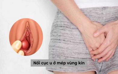 Hiện tượng nổi cục u ở mép vùng kín liệu có nguy hiểm không?