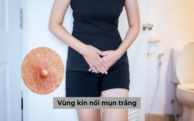 Vùng kín nổi mụn trắng là dấu hiệu bệnh lý phụ khoa nào?