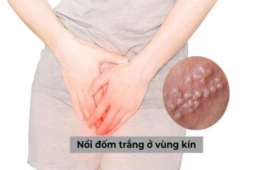 Nổi đốm trắng ở vùng kín là bị làm sao? Cách khắc phục hiệu quả