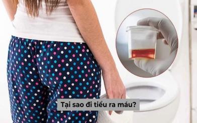 Tại sao đi tiểu ra máu? Lời khuyên của chuyên gia dành cho người bệnh