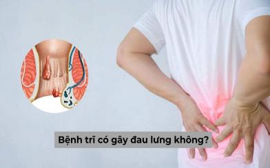 Bệnh trĩ có gây đau lưng không? [Giải đáp thắc mắc]