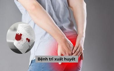 Bệnh trĩ xuất huyết: Tìm hiểu nguyên nhân, dấu hiệu và phương pháp điều trị hiệu quả