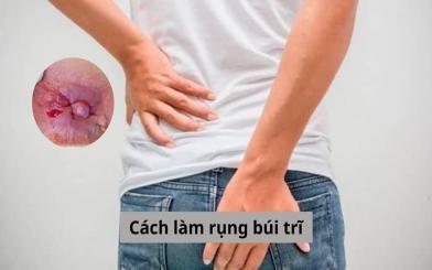 Tổng hợp một số cách làm rụng búi trĩ phổ biến hiện nay
