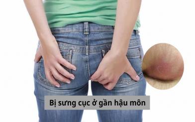 Những vấn đề bạn cần biết khi bị sưng cục ở gần hậu môn
