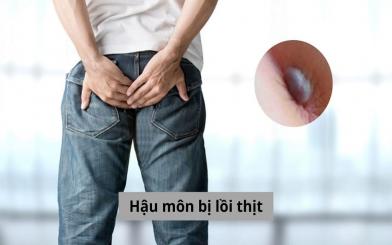 Hậu môn bị lồi thịt: Nguyên nhân và cách điều trị hiệu quả