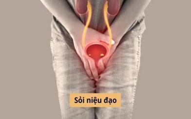 Bệnh sỏi niệu đạo: Tư vấn của bác sĩ chuyên khoa