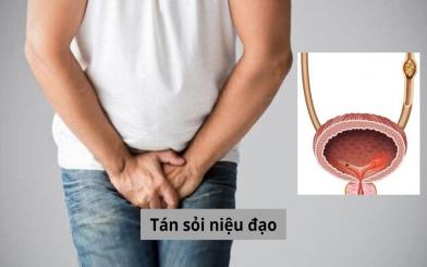 Phương pháp tán sỏi niệu đạo: Quy trình điều trị, ưu điểm và hạn chế