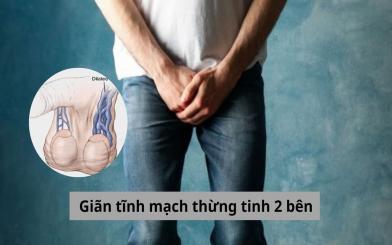 Giãn tĩnh mạch thừng tinh 2 bên: Nguyên nhân và cách điều trị hiệu quả