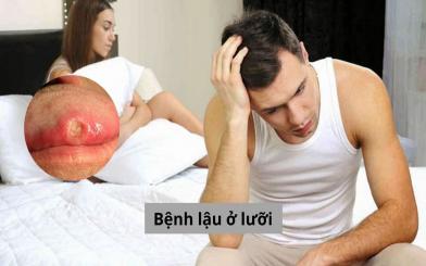 Bệnh lậu ở lưỡi và những thông tin quan trọng bạn cần biết