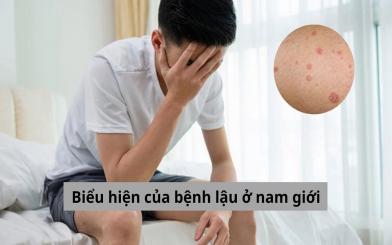 7 biểu hiện của bệnh lậu ở nam giới cần nắm rõ để điều trị hiệu quả