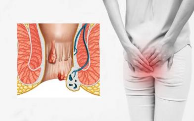 Nhận biết hình ảnh bệnh trĩ qua từng giai đoạn cụ thể