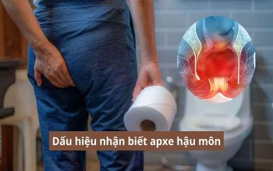 [TRIỆU CHỨNG BỆNH] Chi tiết các dấu hiệu nhận biết áp xe hậu môn điển hình 