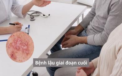 Những vấn đề bạn cần biết về bệnh lậu giai đoạn cuối