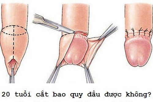 20 tuổi có nên cắt bao quy đầu không?