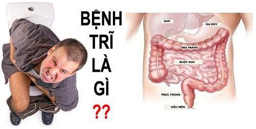 Dấu hiệu, nguyên nhân và cách điều trị bệnh trĩ sẽ giúp mọi người biết cách nhận biết bệnh trĩ