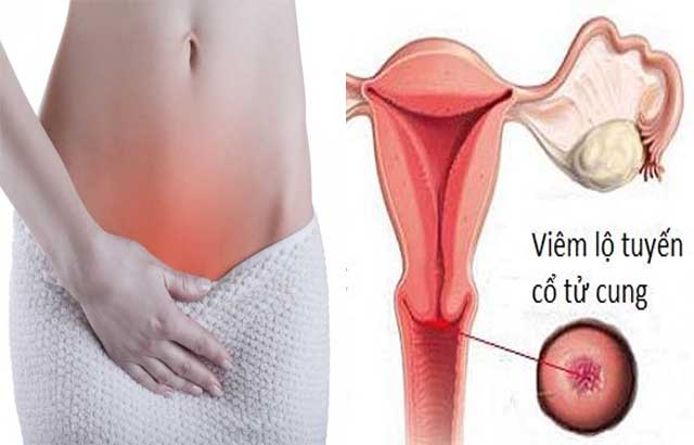 Tìm hiểu phương pháp chữa viêm lộ tuyến cổ tử cung tốt nhất hiện nay