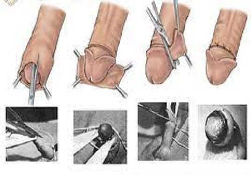 Cắt bao quy đầu giúp nam giới giảm viêm nhiễm