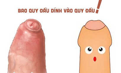 Bao quy đầu dính vào quy đầu