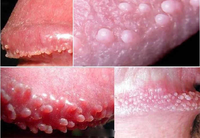 Bao quy đầu nổi mụn trắng lấm tấm là bệnh gì?