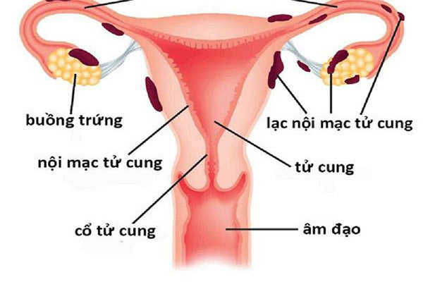 Bệnh lạc nội mạc tử cung