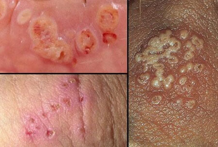 Bệnh lậu mãn tính là gì?