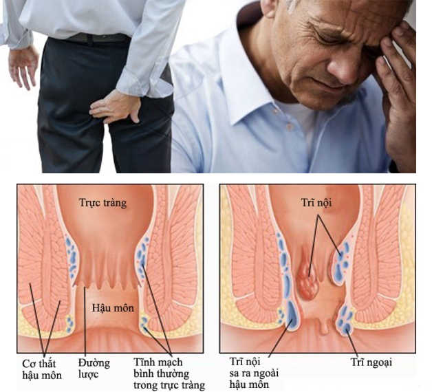 Bệnh lòi dom ở người lớn