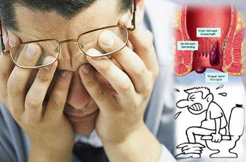 Bệnh lòi dom và cách chữa