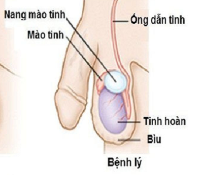 Bệnh nang mào tinh hoàn