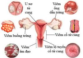 Viêm cổ tử cung: triệu chứng, nguyên nhân và những tác hại nguy hiểm 