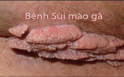 Bệnh sùi mào gà là gì