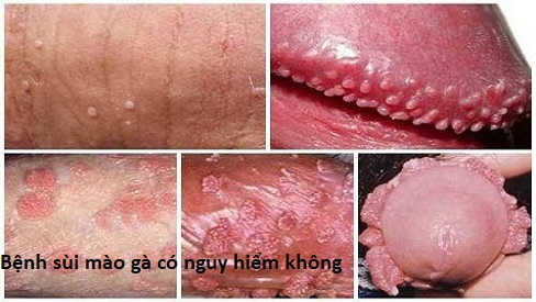 Đốt sùi mào gà có để lại sẹo không? Cách vệ sinh sau đốt