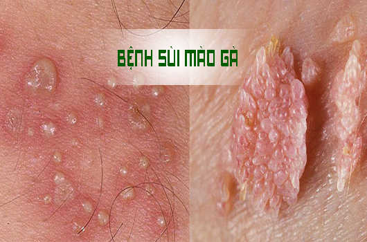 Bệnh sùi mào gà để lâu có sao không