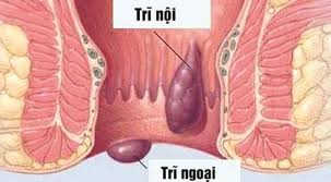 Da thừa cạnh hậu môn- Biểu hiện của bệnh trĩ