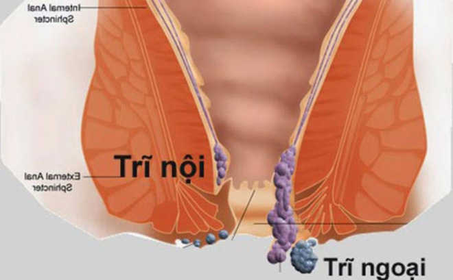 Cắt trĩ nội có đau không, phương pháp cắt trĩ tốt nhất hiện nay