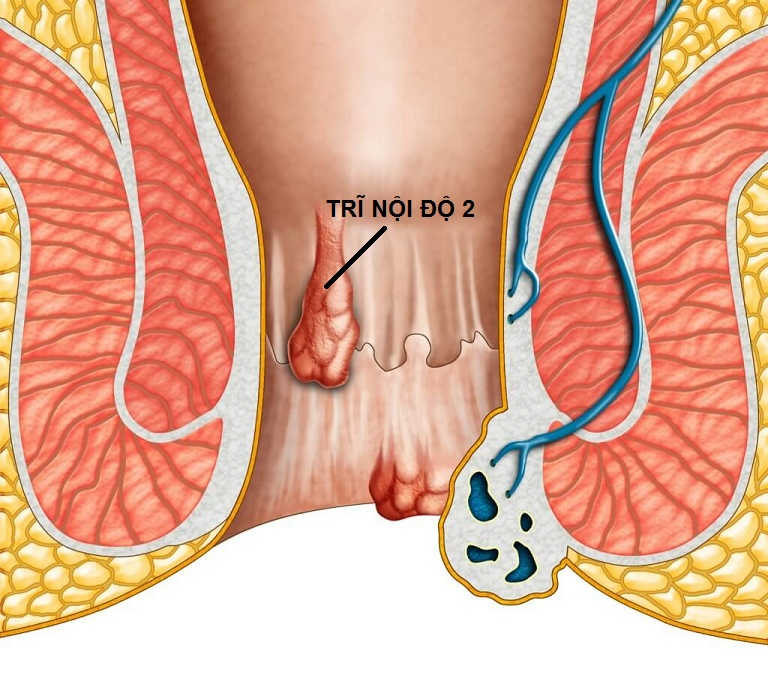 Bệnh trĩ nội độ 2 có nguy hiểm không, không chữa trị có sao không