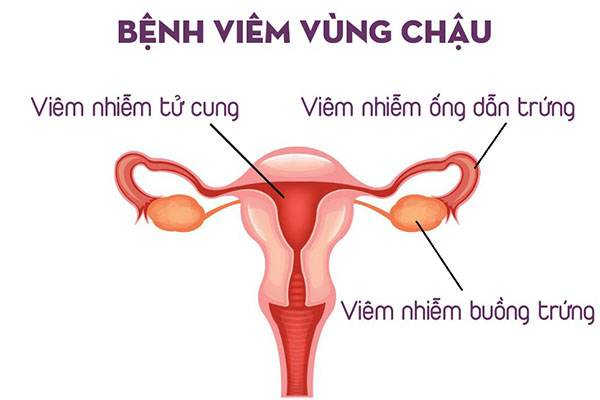 Bệnh viêm vùng chậu