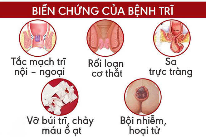 Cách chữa trĩ hiệu quả, nhanh chóng, an toàn 