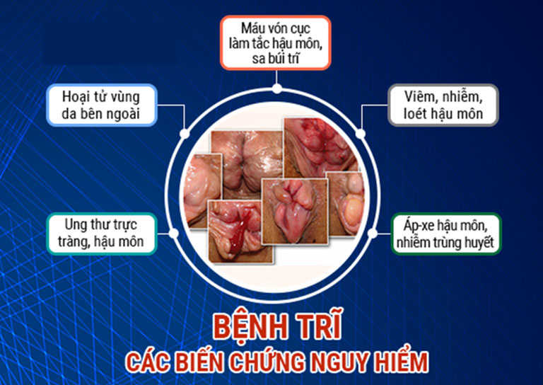 cách điều trị trĩ nhẹ tại nhà an toàn, kín đáo, hiệu quả 