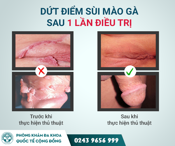 Biện pháp IRA chữa sùi mào gà