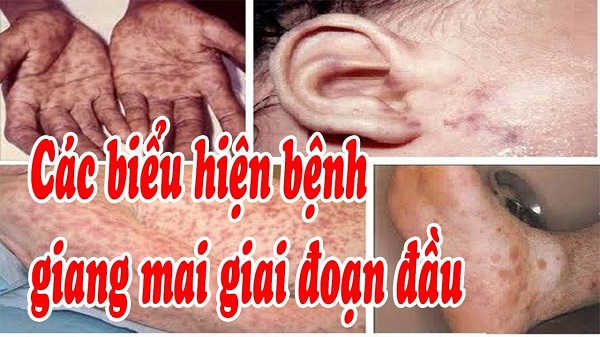 Biểu hiện bệnh giang mai giai đoạn đầu