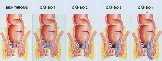 Các cấp độ của bệnh trĩ