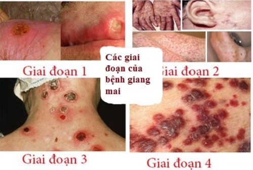 Các giai đoạn bệnh giang mai ở nam giới