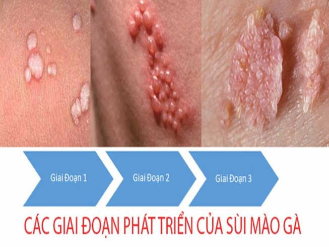 Các giai đoạn phát triển của bệnh sùi mào gà